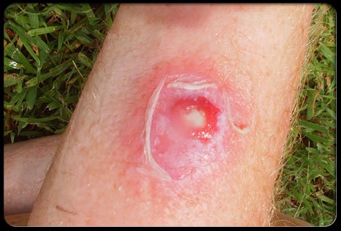 101staph-infection-s4-photo-of-staph-infection