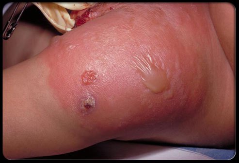 102staph-infection-s5-photo-of-staphylococcal-infection-from-smallpox-vaccination