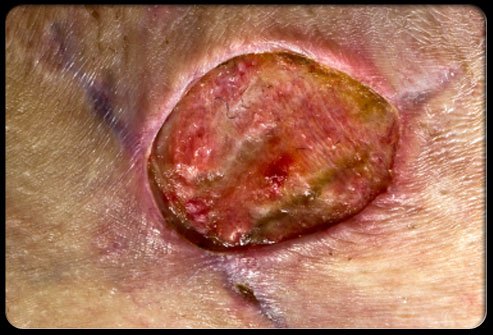 103staph-infection-s10-photo-of-methicillin-resistant-staphylococcus-aureus-infection