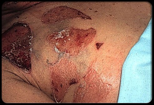 104staph-infection-s11-photo-of-staphylococcal-scalded-skin-syndrome