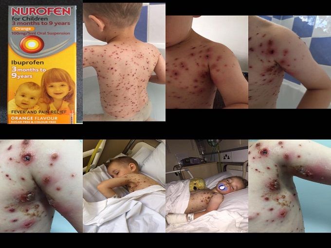 Προσοχή !!!! στα Nurofen για παιδιά … ΚΟΙΝΟΠΟΙΗΣΤΕ ΝΑ ΤΟ ΜΑΘΟΥΝ ΟΛΟΙ ….